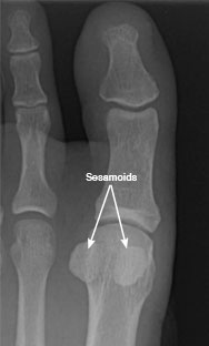 Hairline Fracture Toe Joint