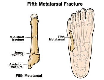 jones fracture foot