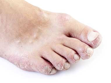 10 Diseases Your Feet Can Reveal, Readers Digest