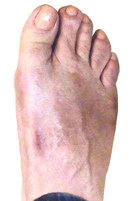 Bunion Surgery Before and After Pictures | State-of-the ...