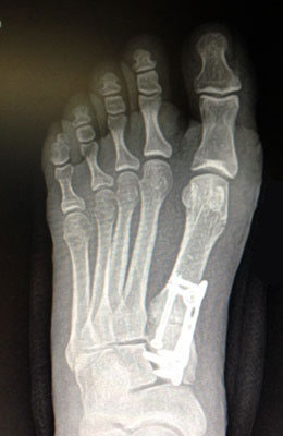 Bunion Surgery Before and After Pictures, State-of-the-Art Results