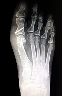 Bunion Surgery Before and After Pictures, Lapidus Bunionectomy