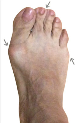 Bunion Surgery Before and After Pictures | State-of-the-Art Results