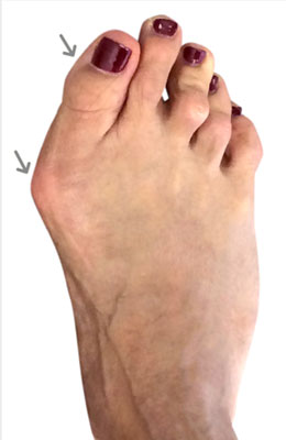 Bunion Surgery Before and After Pictures | State-of-the-Art Results