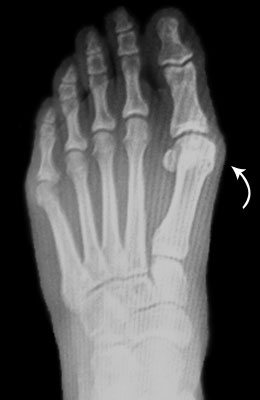 Bunion Surgery Before and After Pictures, Lapidus Bunionectomy