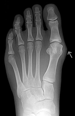 Bunion Surgery Before and After Pictures, State-of-the-Art Results