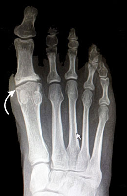 Hallux Rigidus Before and After Pictures, Big Toe Arthritis