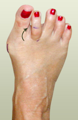 Lapidus Bunionectomy Before and After Pictures, Toe Surgery