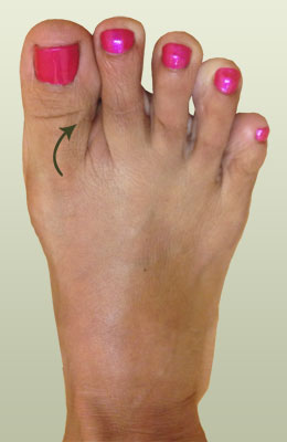 Lapidus Bunionectomy Before and After Pictures, Toe Surgery