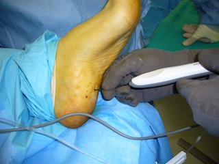 Topaz Procedure for Heel Pain and Plantar Fasciitis