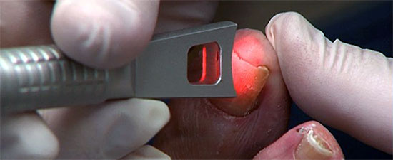 Onychomycosis, Toenail Fungus Laser Treatment