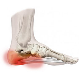 Exercises to Help Heal Your Sprained Ankle - Custom Orthotics Blog - Upstep