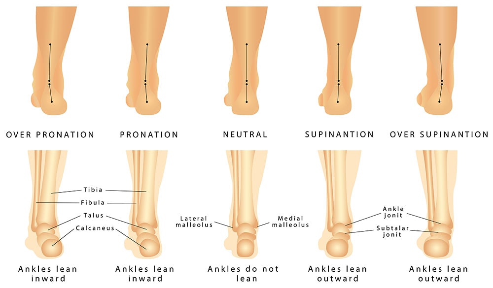 4 Questions to Ask Your Heel Spur Specialist