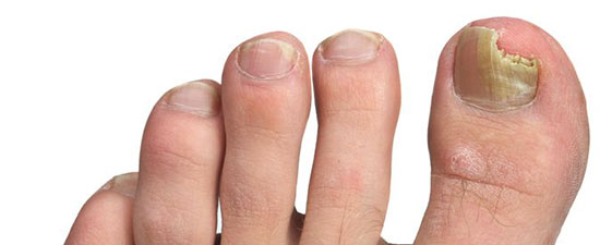 nail-fungus-sucks-it-s-time-to-learn-what-causes-it-and-how-to-kill-it