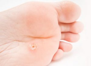 11 Most Common Foot Lumps and Bumps 