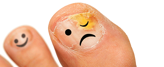 Help My Toenail Is Falling Off What Do I Do Foot Ankle Blog