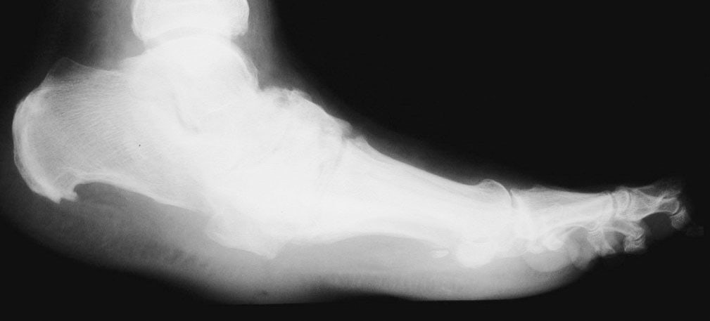 Everything you need know about Charcot Foot but were afraid to ask