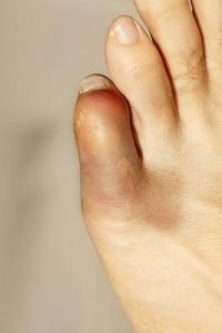pinky toe hurts in heels