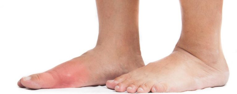 got-big-toe-bumps-and-lumps-here-s-5-things-you-need-to-know