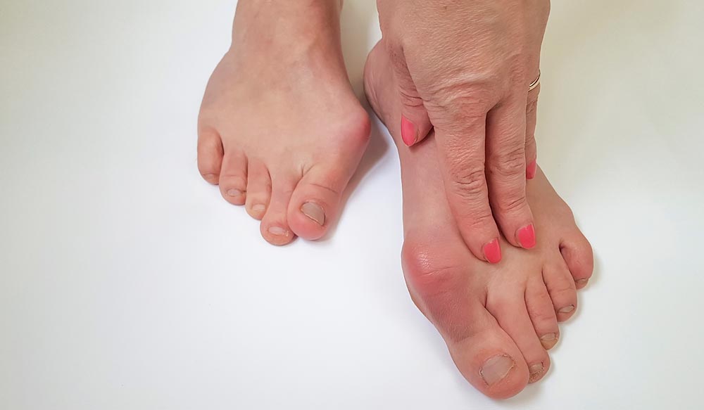 Finally A Non Surgical Bunion Treatment That Works
