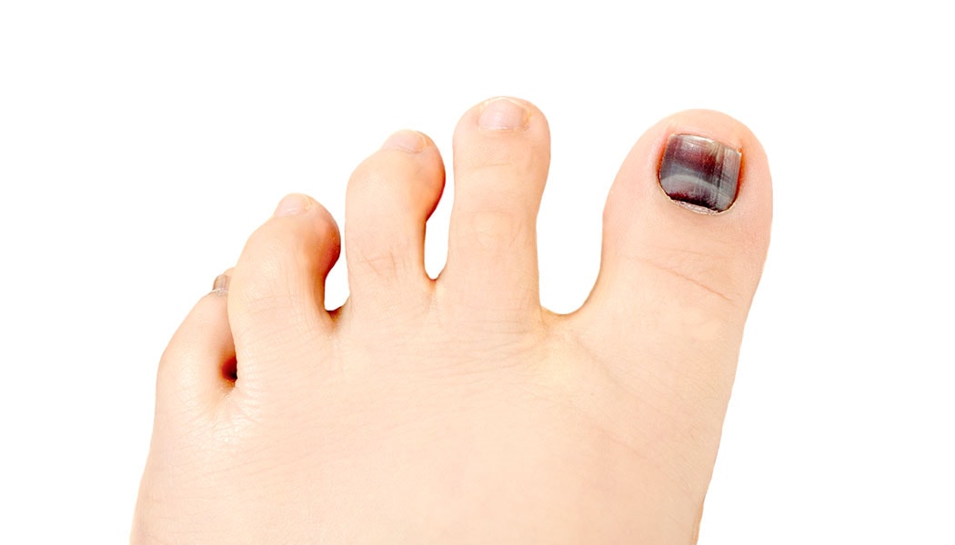 What Causes A Black Toenail Should You Be Worried UFAI Blog