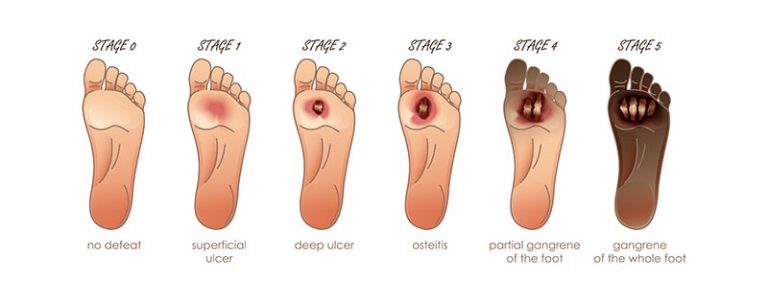 diabetic-foot-ulcer-advanced-diabetic-foot-care-university-foot-and