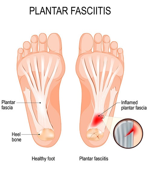 FOOT & ANKLE PAIN | HEEL PAIN | SPRAINS | FRACTURES | TENDONITIS — Advanced  Feet & Ankle Care