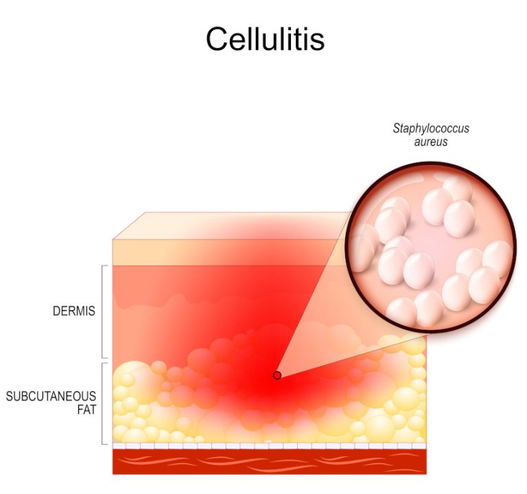 What Is Foot Cellulitis How To Prevent It And When To Worry