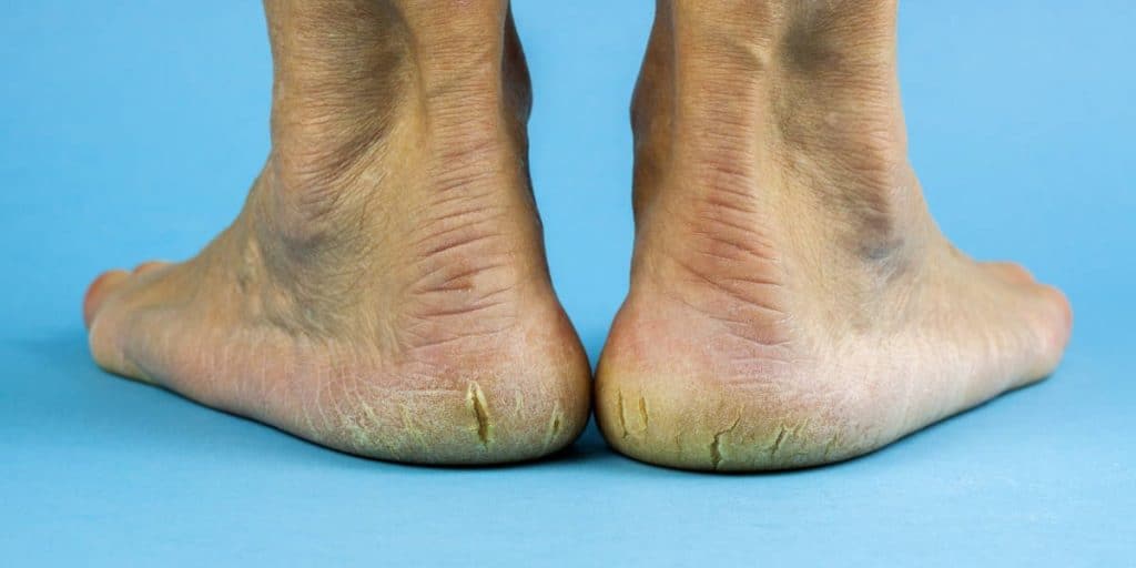 Why do I have dry, cracked heels? – Barefoot Scientist
