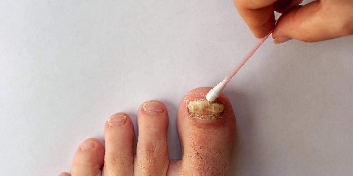 What To Do If Your Toenail Is Falling Off