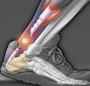 Achilles Tendon Rupture | University Foot and Ankle Institute