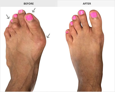 Types of Bunion Surgery | Lapidus Bunionectomy