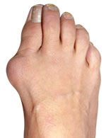 Do I Need Bunion Surgery? Expert Bunion Care