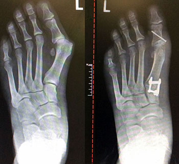 Types of Bunion Surgery | Lapidus Bunionectomy