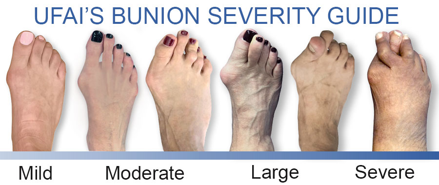 tailors bunion surgery before and after