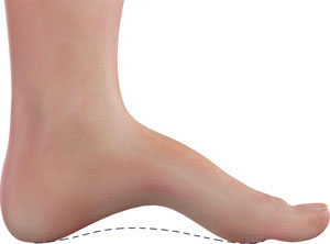 Cavus Foot: causes, symptoms and 