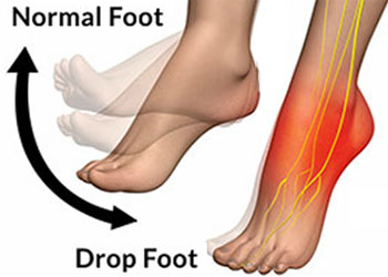 UNDERSTANDING WHAT IS 'FOOT DROP” AND ITS SYMPTOMS, CAUSES AND TREATMENT