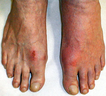 Why Does Gout Affect the Big Toe?