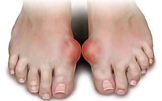 gout bottom of foot