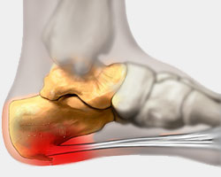 exostosis on top of foot