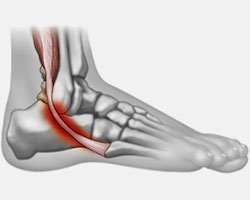 Posterior Tibal Tendon Dysfunction, Podiatrist Los Angeles